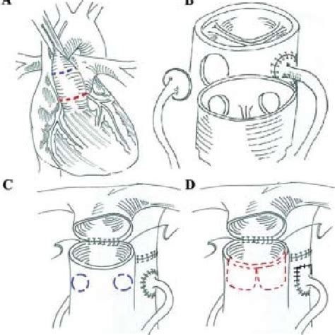 Complications and sequalae after arterial switch operation | Download ...