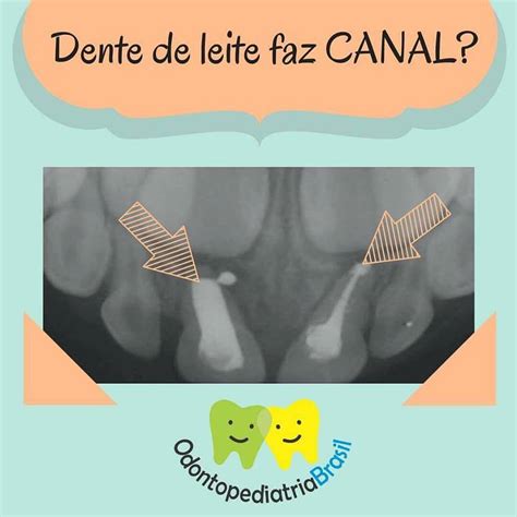 Dente De Leite Faz Canal Odontopediatria Brasil