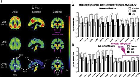 Amyloid PET Imaging PET Clinics