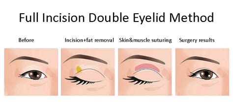 Full Incision Method of Double Eyelid Surgery » Grace Chua