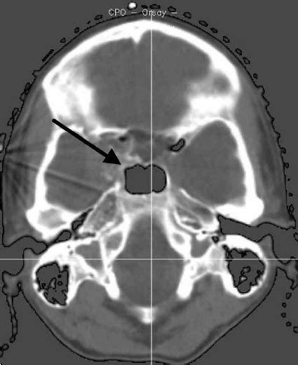 CT scan of a chondrosarcoma of the base of the skull ( 0 / ) at ...