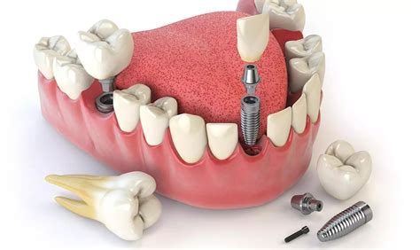 Box Technique To Regain Bone For Implants Sites Dentart Implant