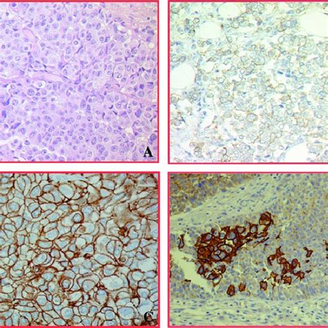 Pathologic Immunohistochemistry Labeling Results Of Invasive Urothelial