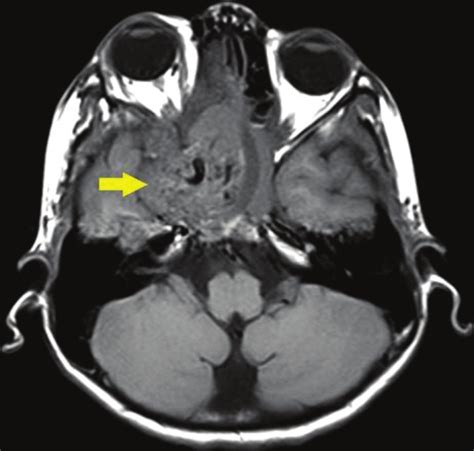 Imaging In The Diagnosis Of Juvenile Nasopharyngeal Angiofibroma