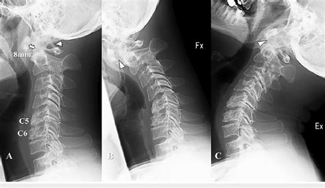 Radiography Images At The Initial Visit A Lateral Plain Radiography