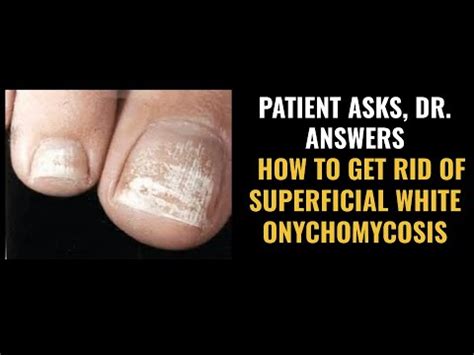 Do you suffer from White Onychomycosis? Here's the best tips to treat ...