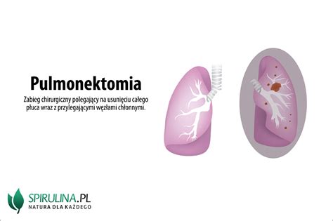 Pulmonektomia Algi Spirulina I Chlorella