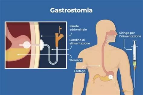 Gastrostomia Endoscopica Percutanea PEG