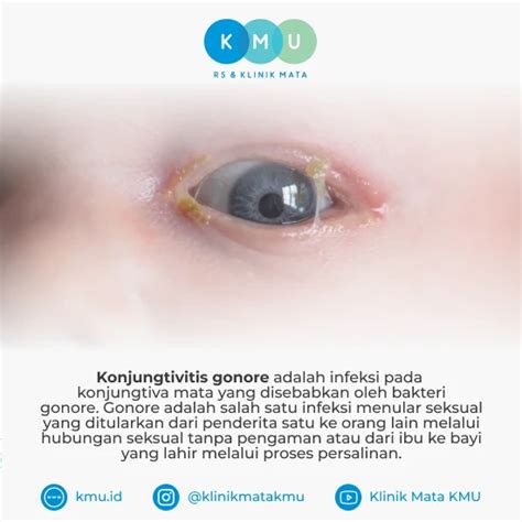 Ilustrasi gonore apakah bisa disembuhkan