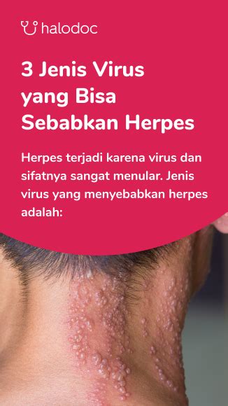 Apa Itu Herpes Zoster Yang Viral Di Medsos Bagaimana Gejalanya Sexiz Pix