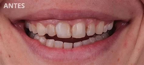 Correcci N De Sonrisa Gingival Y Carillas De Porcelana Autr N Dental