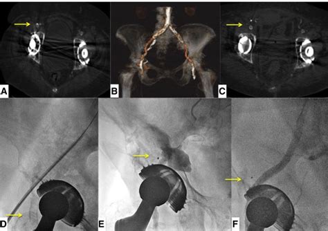 Early Outcomes After Percutaneous Closure Of Access Site In