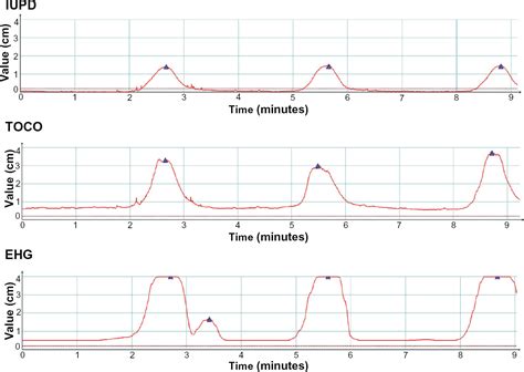 Accuracy And Reliability Of Uterine Contraction Identification Using Abdominal Surface