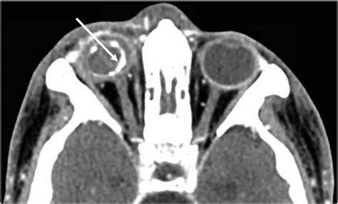 Axial CT showing the right phthisical eye. The right globe is smaller ...