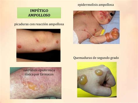 Impetigo Infeccion Bacteriana De La Piel Pediatria Salud Images