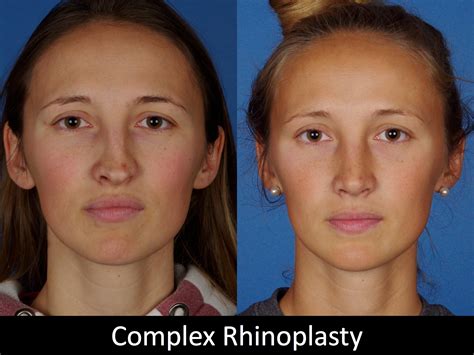 Denver Rhinoplasty Before And Afters Raval Facial Aesthetics