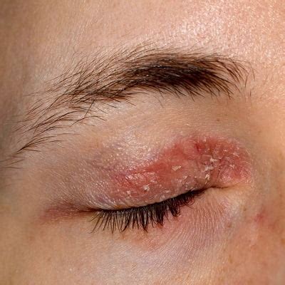 Eyelid Dermatitis Eczema Symptoms Causes And Treatment Atelier