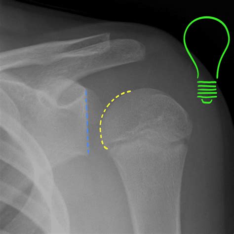 light-bulb-sign - Emergency Medicine Cases