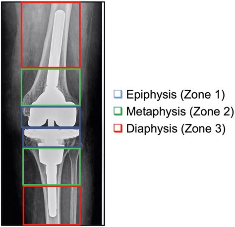 Standardized Fixation Zones And Cone Assessments For Revision Total