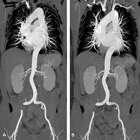 Radiation Dose And Image Quality At High Pitch Ct Angiography Of The