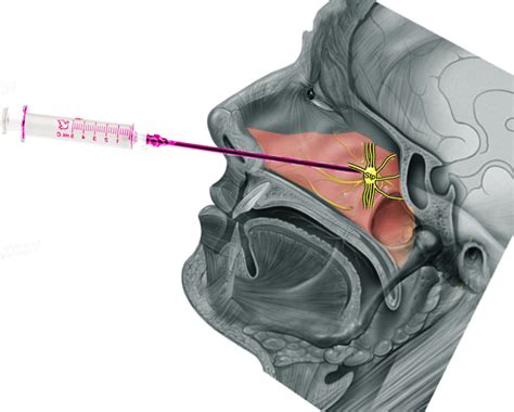 Sphenopalatine Ganglioneuralgia