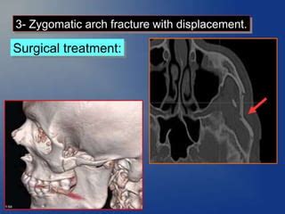 Zygomatic Complex Fracture Ppt