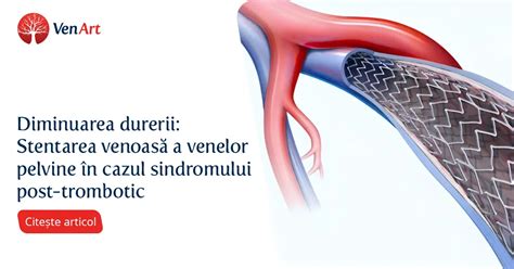 Tratamentul Minim Invaziv Al Sindromului Post Trombotic