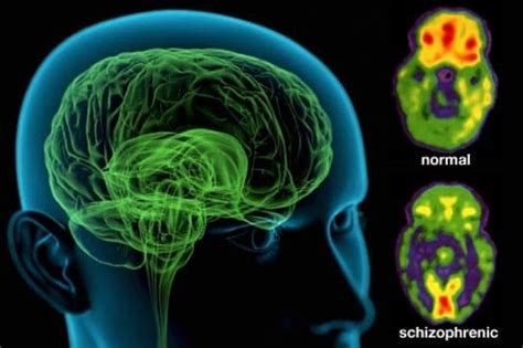 Cientistas descobrem parte do cérebro em que esquizofrênicos ouvem