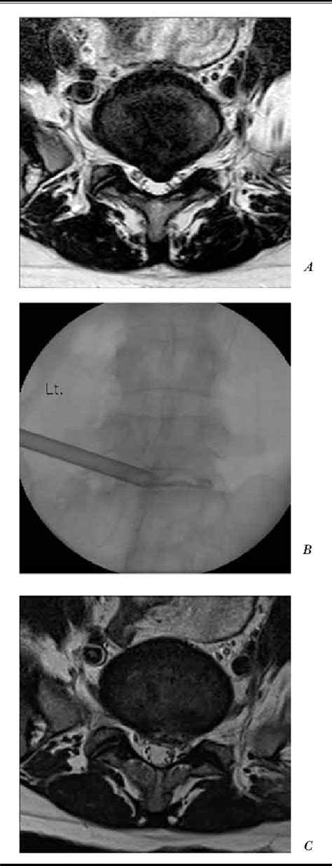 Percutaneous Endoscopic Lumbar Discectomy For L5 S1 Disc Herniation