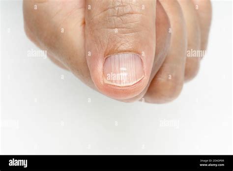 White Spots And Vertical Ridges On The Fingernails Symptoms Deficiency