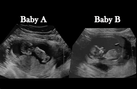 9 Week Ultrasound Identical Twins