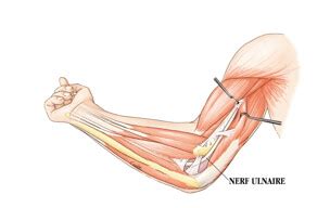 Compression du nerf ulnaire au coude Pathologies Institut Européen