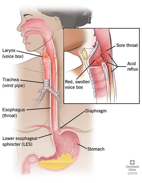 Laryngopharyngeal Reflux LPR The Gerd Wikipedia