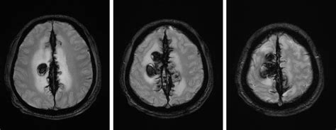 Sagittal Sinus Hemorrhage