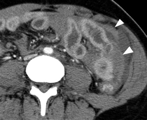 Evaluation Of Bowel And Mesenteric Blunt Trauma With Multidetector CT