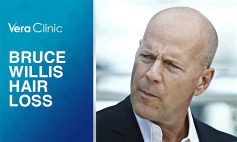 Bruce Willis Hair Loss A Story Of Confidence And Charisma