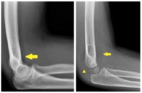 Normal Pediatric Elbow X Ray