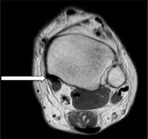 Posterior Tibial Tendon MRI