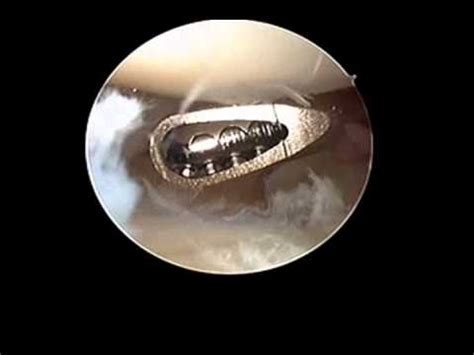 Tfcc Ligament Tear Repair