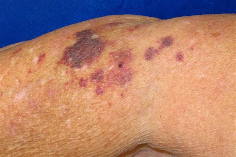 Non Blanching Rash Meaning With Fever Treatment