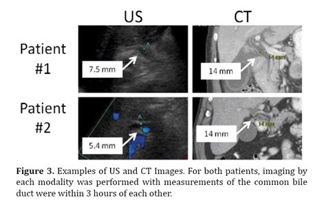 Does Computed Tomography Ct Overestimate Common Bile Duct Diameter In