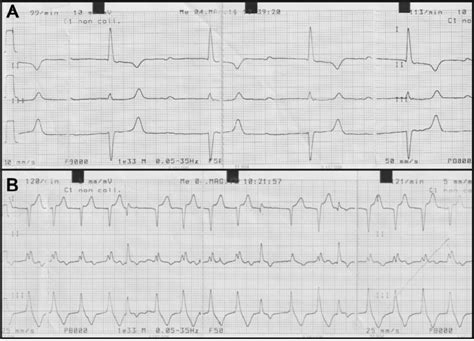 Electrocardiogram Ecg Traces Showing Two Representative Observed