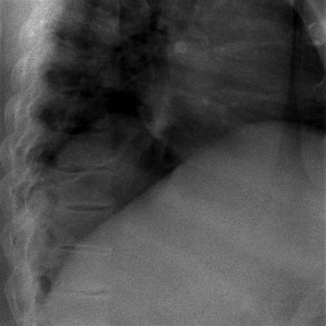 Posteroanterior Thoracolumbar Spine Radiography Shows Mild Scoliosis To