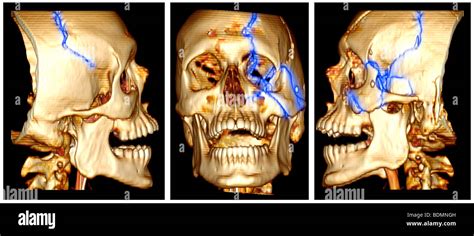 Skull fracture trauma hi-res stock photography and images - Alamy