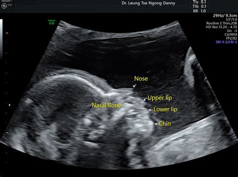 Nasal Bone Ultrasound