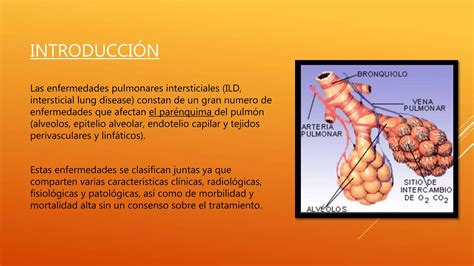 Enfermedades Pulmonares Intersticiales PPT