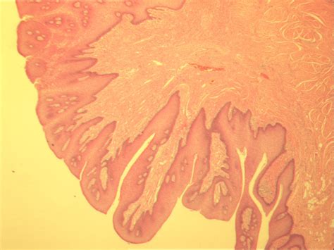 Hyperkeratinized Stratified Squamous Hyperplastic Epithelium With