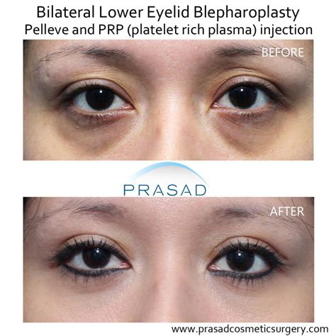 Benefits Of Prp Injection Under Eyes Dr Prasad New York