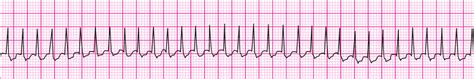 Supra Ventricular Tachycardia Svt Time Of Care