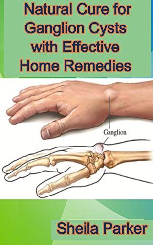 Natural Cure For Ganglion Cysts With Effective Home Remedies By Sheila Parker Goodreads